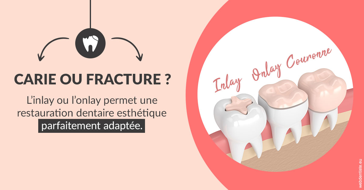 https://docteur-sabine-teiten.chirurgiens-dentistes.fr/T2 2023 - Carie ou fracture 2