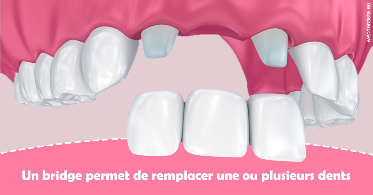 https://docteur-sabine-teiten.chirurgiens-dentistes.fr/Bridge remplacer dents 2