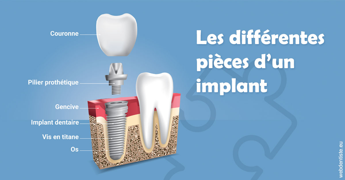 https://docteur-sabine-teiten.chirurgiens-dentistes.fr/Les différentes pièces d’un implant 1